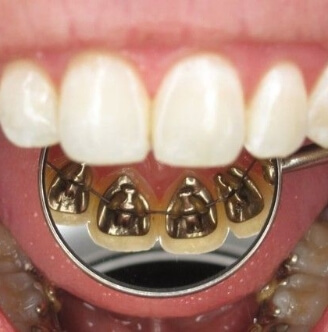 Brackets linguales